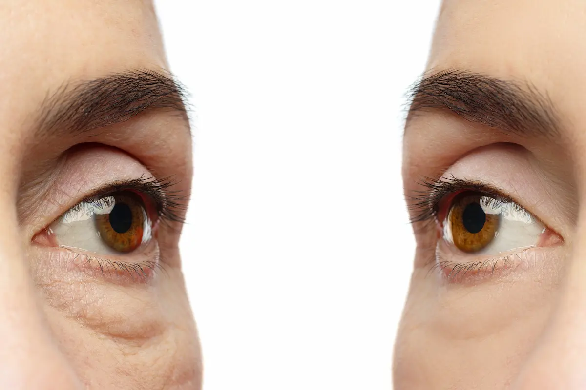 como quitar ojeras