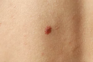 tumor cutáneo benigno