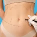 beneficios de la lipoescultura