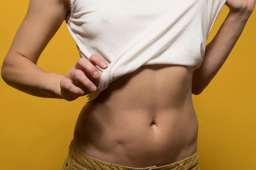 mujer sin piel sobrante por abdominoplastia eliminar piel sobrante de abdomen definitivamente