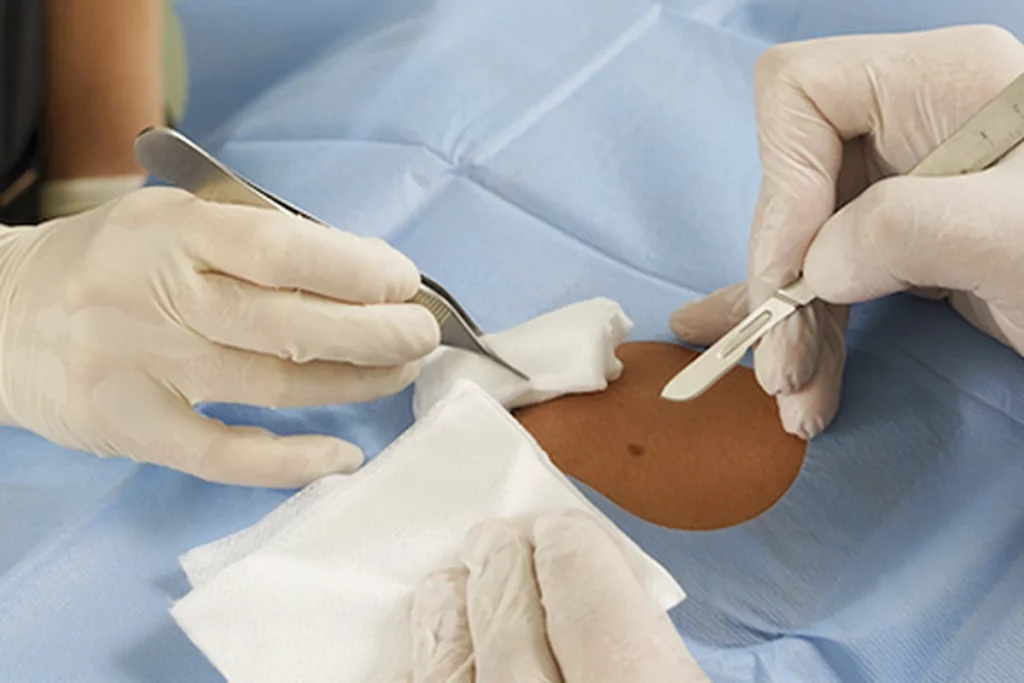 cirugia dermatologica ambulatoria cómo se opera un cáncer de piel