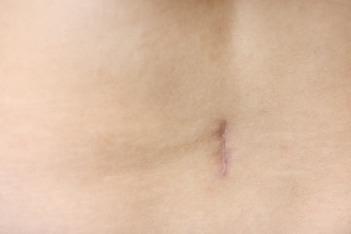 cicatriz abdominal bien cuidada como cuidar la cicatriz de una abdominoplastia