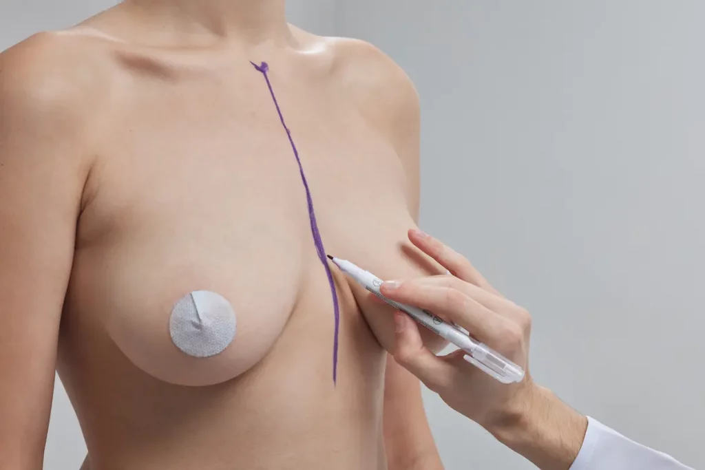 marcaje preoperatorio para mastopexia como se hace un levantamiento de pecho