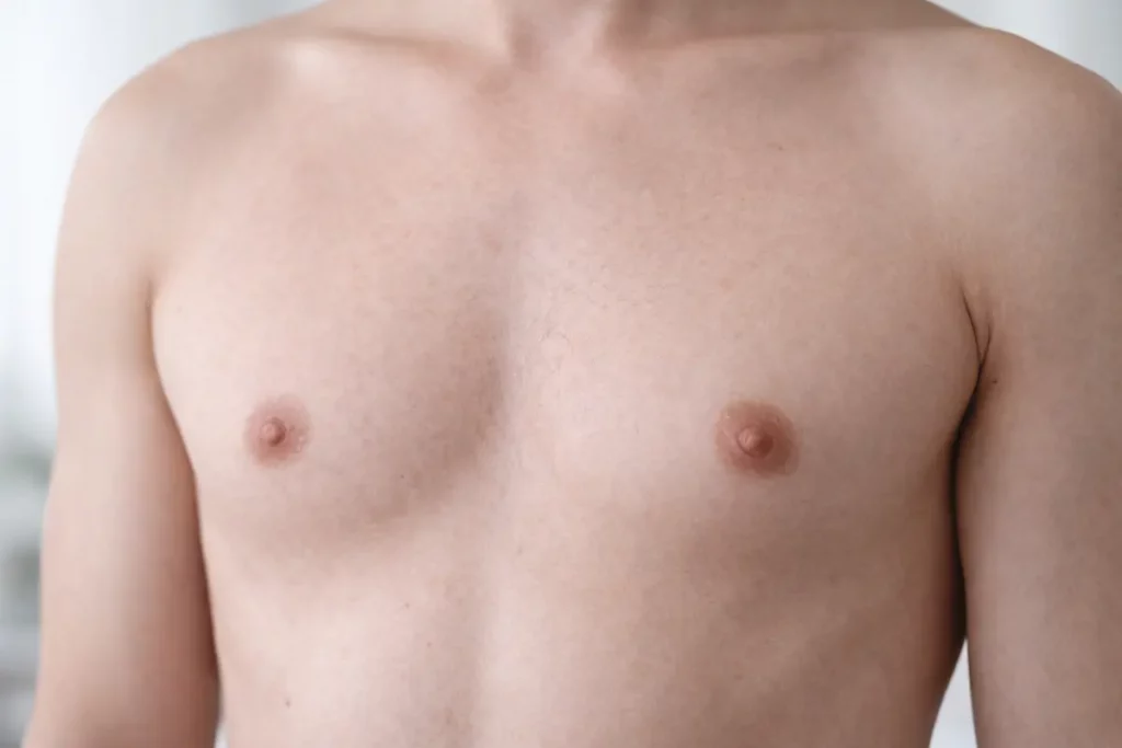 una ginecomastia de grado uno ginecomastia masculina