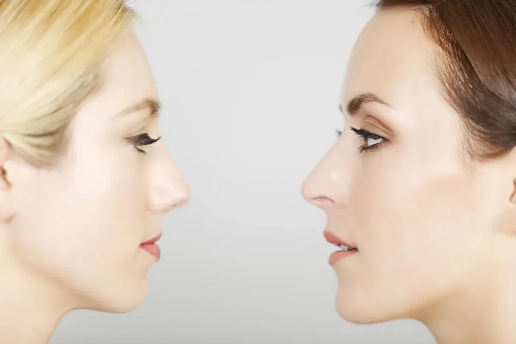 dos mujeres con rinoplastia comparativa rinoplastias