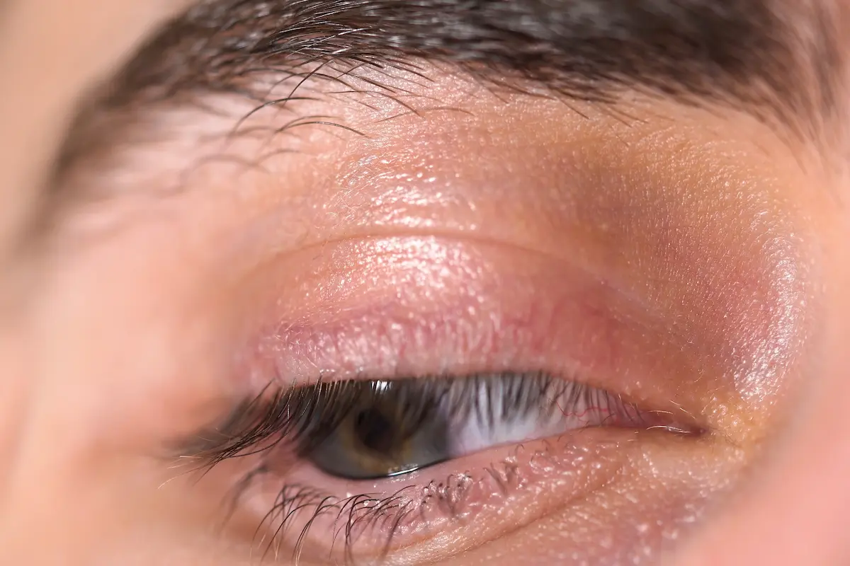 primer plano parpado caido cómo tratar el párpado caído