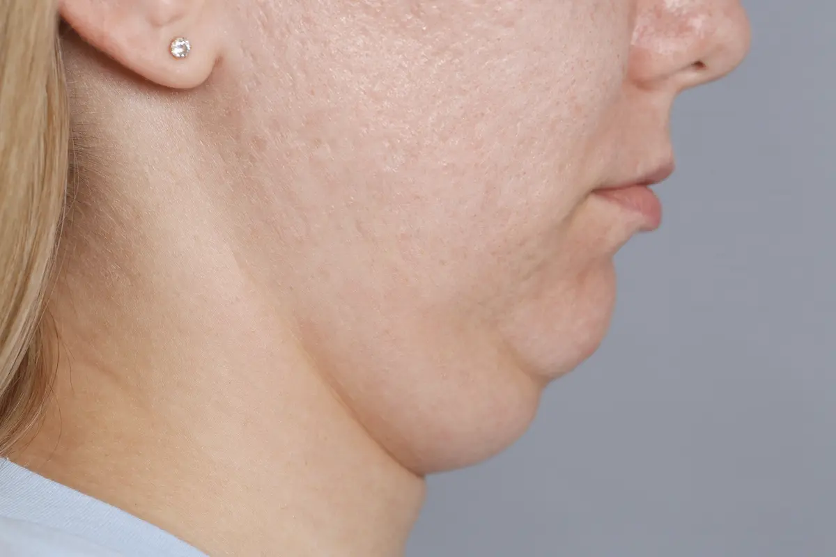 mujer con papada en primer plano cómo quitar la papada