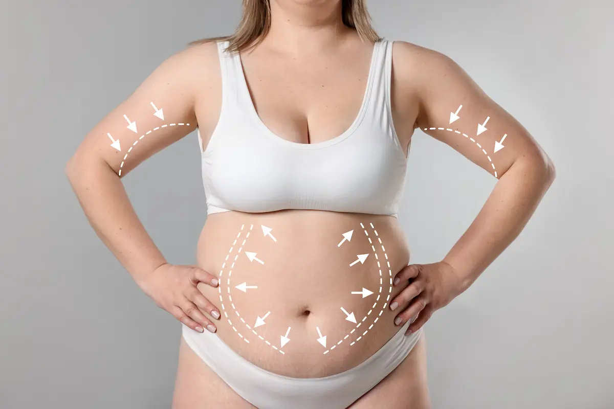paciente para lipoescultura como se hace la lipoescultura